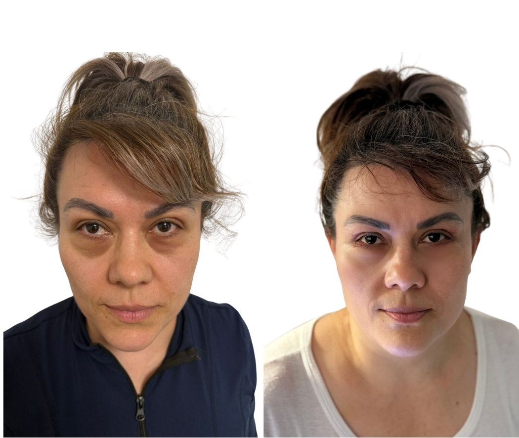Antes y después Blefaroplastia