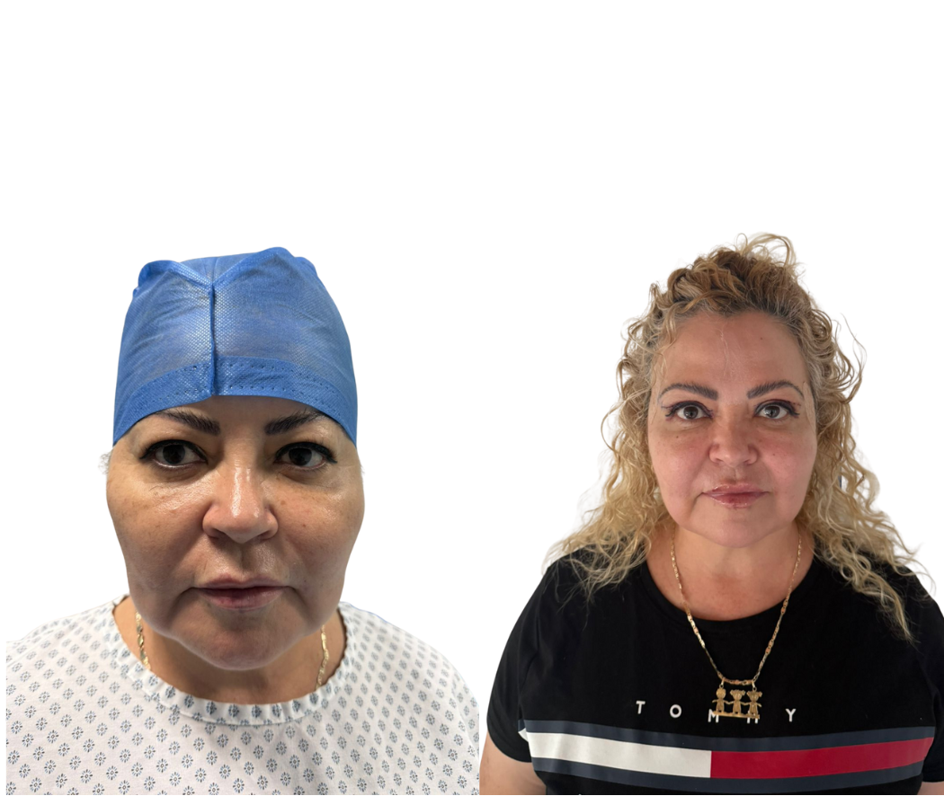 Antes y después Blefaroplastia caso 2