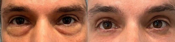 Antes y después Blefaroplastia caso 3