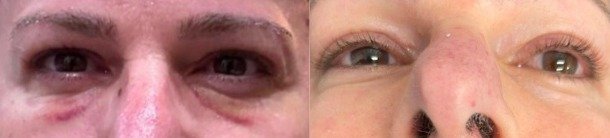 Antes y después Blefaroplastia caso 5