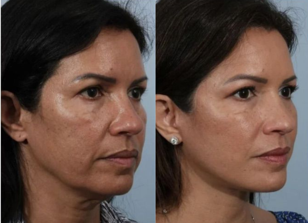 Antes y después Endolift Caso 1