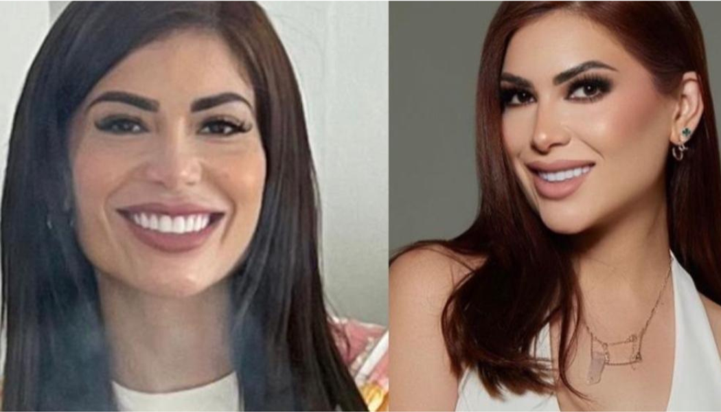 Antes y después Endolift Caso 2