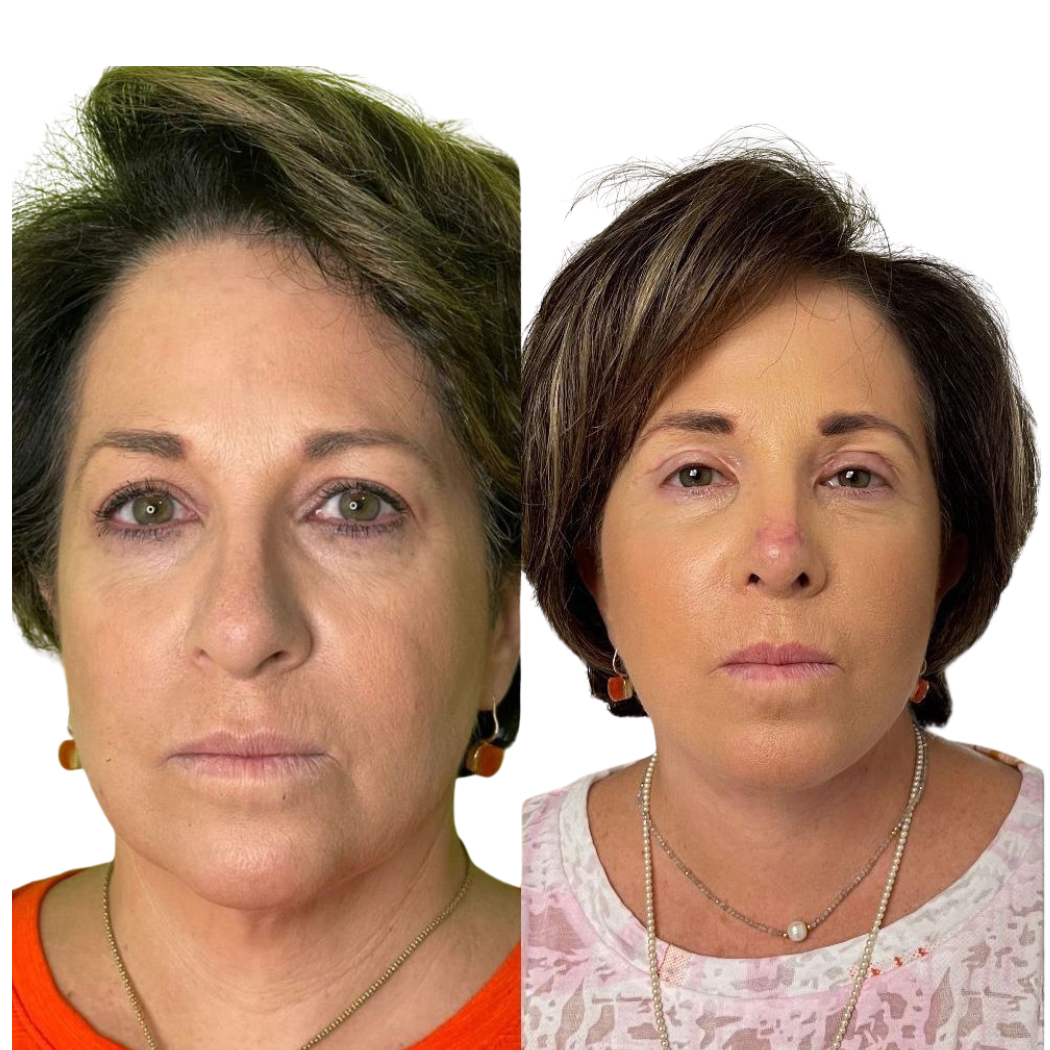 Antes y después Mini Facelift Caso 2