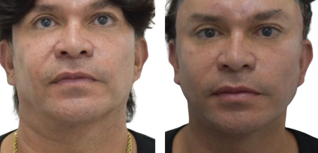 Antes y después Mini Facelift Caso 4