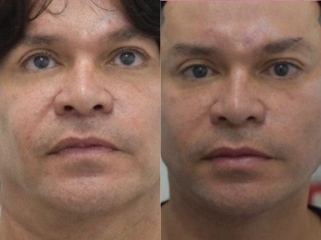 Antes y después Mini Facelift Caso 4