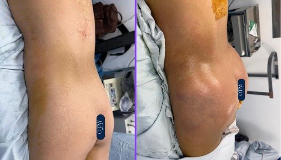 Antes y después Mini lipo bbf caso 3