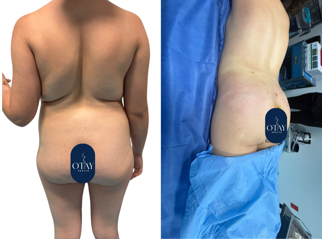 Antes y después Mini lipo caso 1