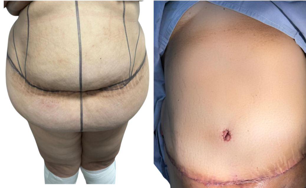 Antes y después de abdominoplastia caso 1