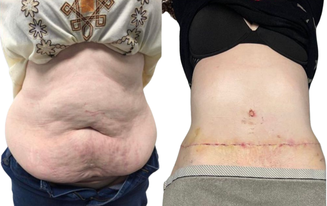 Antes y después de abdominoplastia caso 3