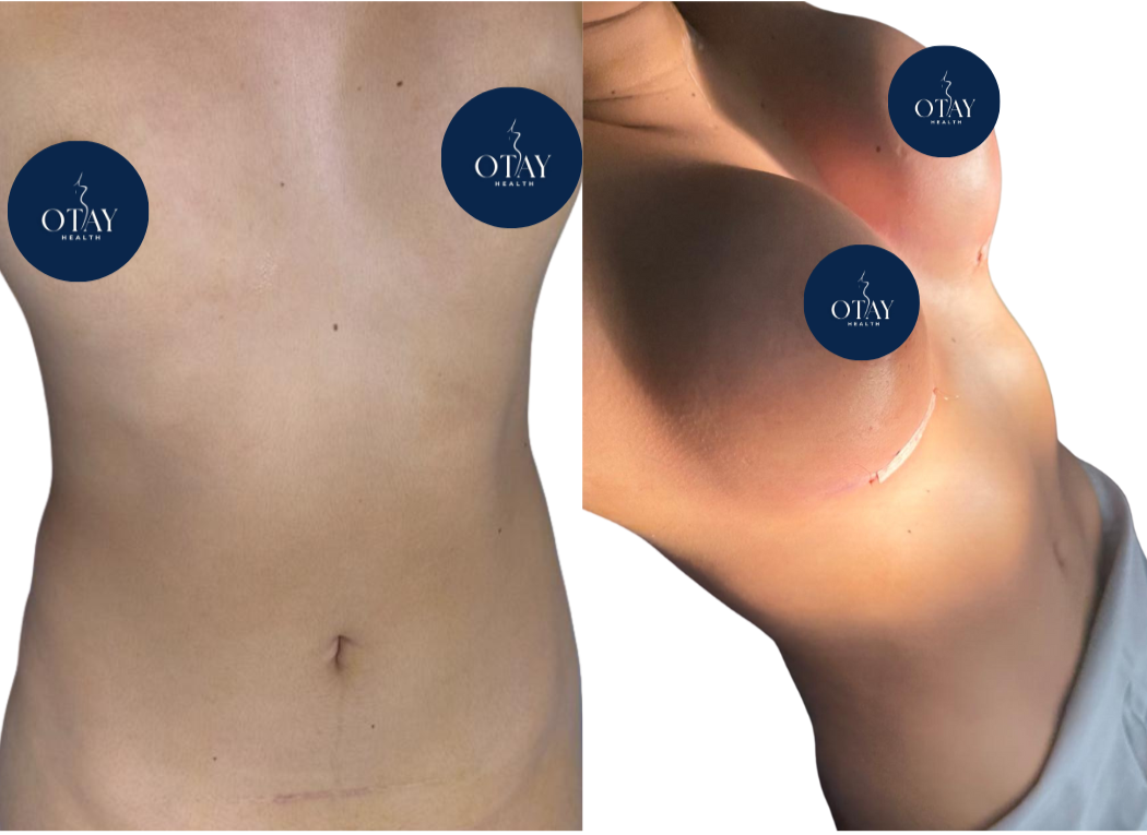 Antes y después implantes de seno caso 1