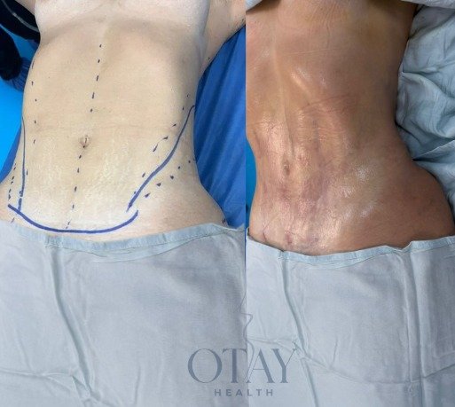 Antes y después de liposuccion caso 2