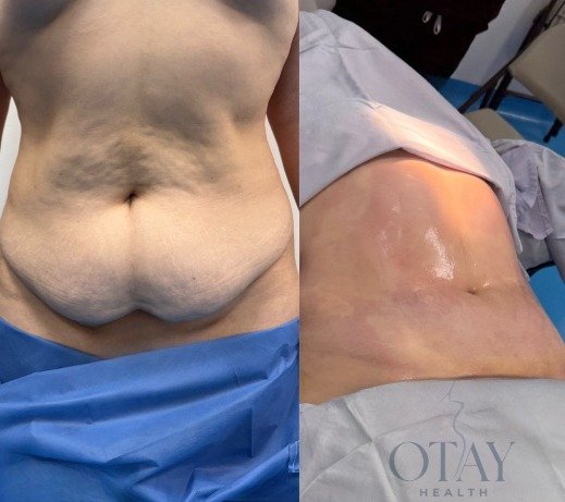 Antes y después de liposuccion caso 3